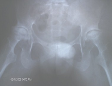 artritis_reumatoide_cadera/destruccion_cabeza_femur artritis_reumatoide_cadera/destruccion_cabeza_femur