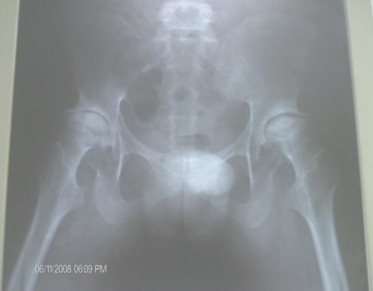 artritis_reumatoide_cadera/radiografia_pelvis_osea artritis_reumatoide_cadera/radiografia_pelvis_osea