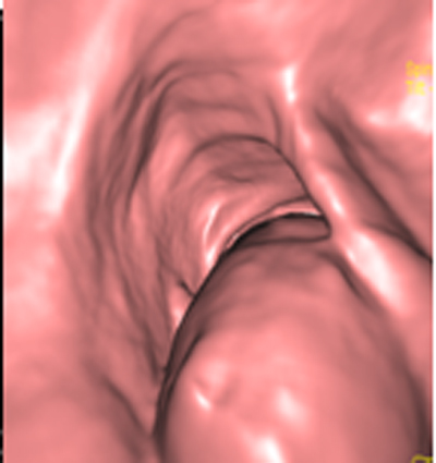 colonoscopia_virtual_convencional/reconstruccion_en_3d