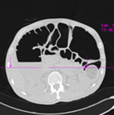colonoscopia_virtual_convencional/tc_corte_axial colonoscopia_virtual_convencional/tc_corte_axial