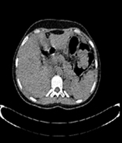 colonoscopia_virtual_convencional/tc_corte_axial2 colonoscopia_virtual_convencional/tc_corte_axial2