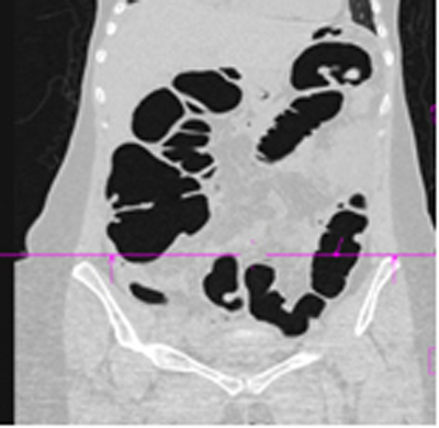 colonoscopia_virtual_convencional/tc_corte_coronal3