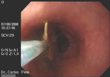 cuerpos_tracto_digestivo/extraccion_via_endoscopica