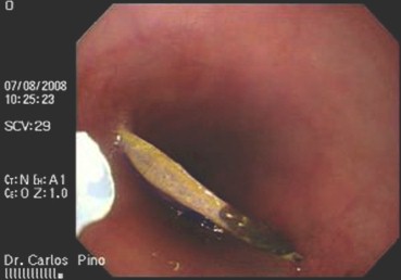 cuerpos_tracto_digestivo/tratamiento_endoscopico_endoscopia