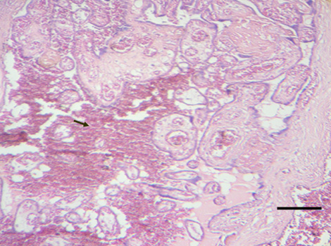 embarazadas_infectadas_VIH/trombosis_intervellosa_placenta embarazadas_infectadas_VIH/trombosis_intervellosa_placenta