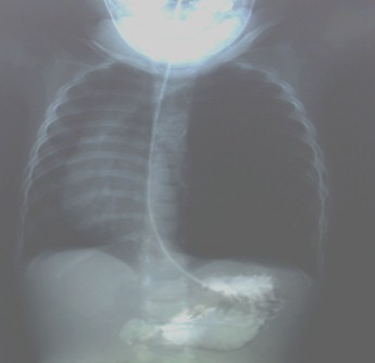 enfisema_lobar_congenito/CONTRASTADO_BARIO_GASTROINTESTINAL enfisema_lobar_congenito/CONTRASTADO_BARIO_GASTROINTESTINAL