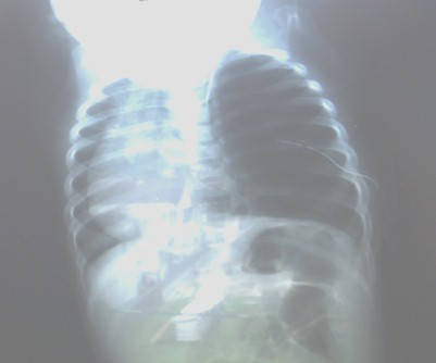 enfisema_lobar_congenito/RAYOS_TORAX enfisema_lobar_congenito/RAYOS_TORAX