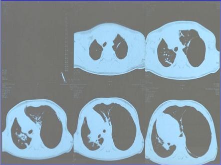 enfisema_lobar_congenito/TAC_TORAX