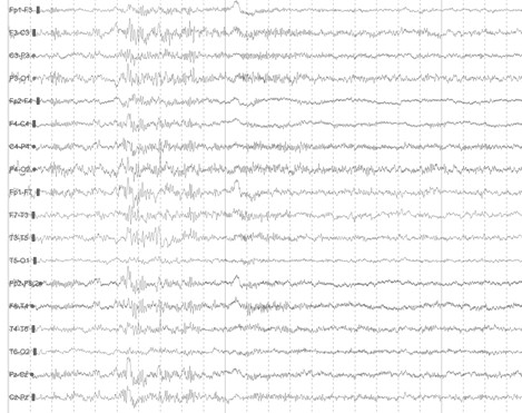 epilepsia_agua_caliente/ondas_EEG_ictal