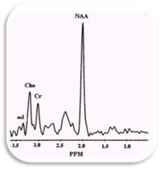 espectroscopia_resonancia_magnetica/espectro_normal_cerebral