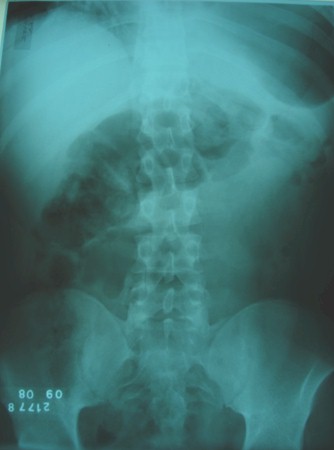 hernia_diafragmatica_traumatica/rx_caso_clinico