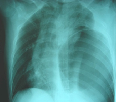 hernia_diafragmatica_traumatica/rx_caso_clinico_2