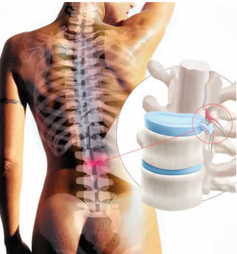 hernia_disco_lumbar/diagnostico_hernia_lumbar hernia_disco_lumbar/diagnostico_hernia_lumbar
