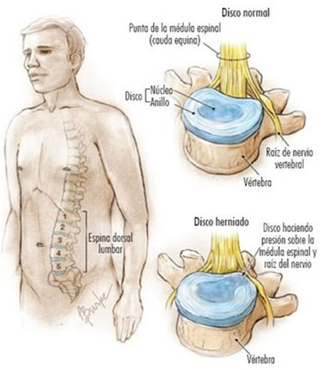 hernia_disco_lumbar/hernia_disco_lumbar