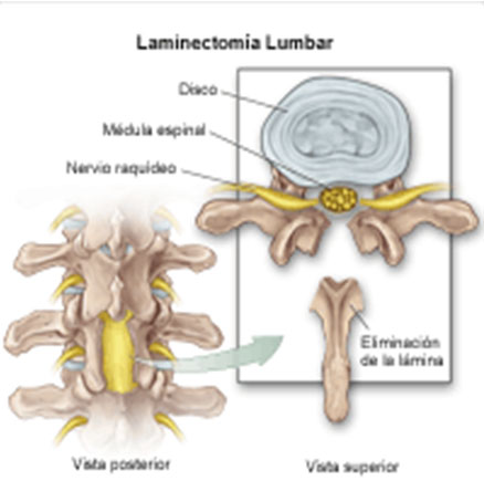 hernia_disco_lumbar/tecnicas_quirurgicas_laminotomia