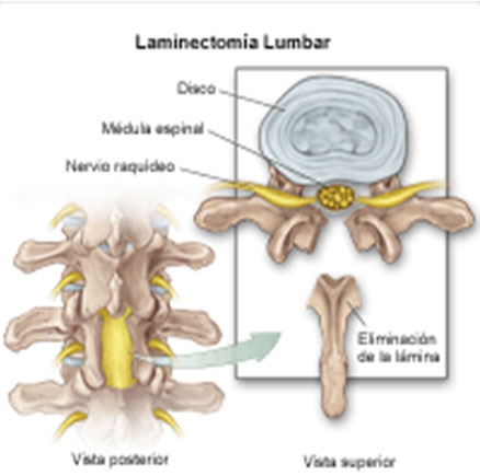 hernia_disco_lumbar/tecnicas_quirurgicas_laminotomia hernia_disco_lumbar/tecnicas_quirurgicas_laminotomia