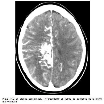 malformacion_malformaciones_arteriovenosas/fig2_tac_contrastada