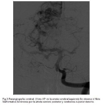 malformacion_malformaciones_arteriovenosas/fig3_vista_ap_vertebral_izq