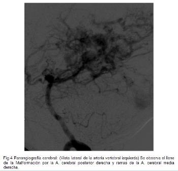 malformaciones_arteriovenosas/fig4_vista_lat_vertebral_izq