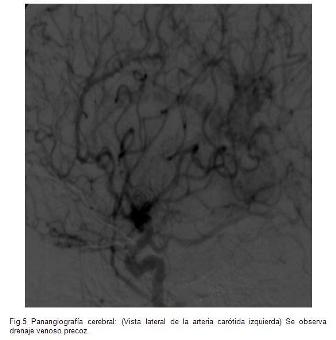 malformacion_malformaciones_arteriovenosas/fig5_vista_lat_carotida_izq