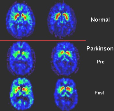 patogenia_enfermedad_parkinson/PET_SCAN_tomografia