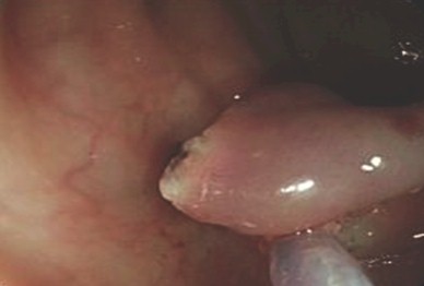 polipo_polipectomia_endoscopica/asa polipo_polipectomia_endoscopica/asa