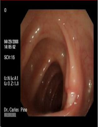 polipo_polipectomia_endoscopica/cicatriz_polipectomia1