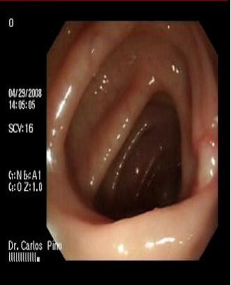 polipo_polipectomia_endoscopica/cicatriz_polipectomia2