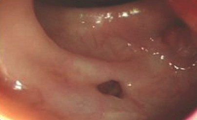 polipo_polipectomia_endoscopica/diverticulos_colon_sigmoide polipo_polipectomia_endoscopica/diverticulos_colon_sigmoide
