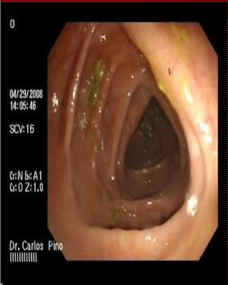polipo_polipectomia_endoscopica/mucosa_colon polipo_polipectomia_endoscopica/mucosa_colon