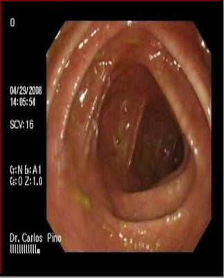 polipo_polipectomia_endoscopica/mucosa_colon2 polipo_polipectomia_endoscopica/mucosa_colon2