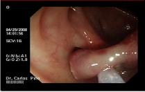 polipo_polipectomia_endoscopica/pediculo polipo_polipectomia_endoscopica/pediculo