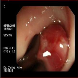 _polipo_polipectomia_endoscopica/polipo_colon