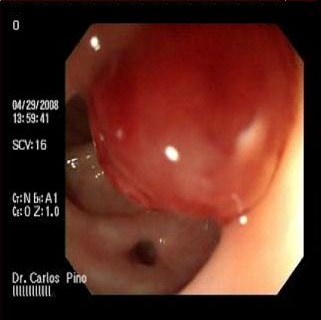 polipo_polipectomia_endoscopica/polipo_colon2