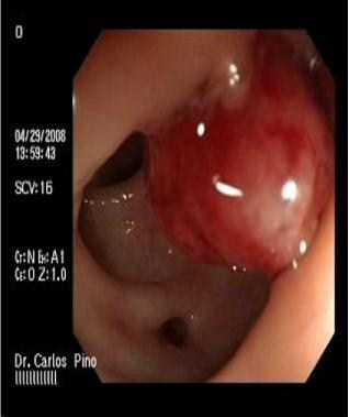 polipo_polipectomia_endoscopica/polipo_diverticulo