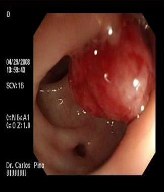 polipo_polipectomia_endoscopica/polipo_diverticulo2 polipo_polipectomia_endoscopica/polipo_diverticulo2