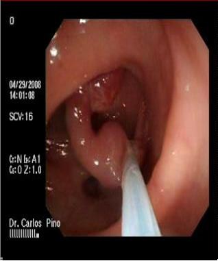 polipo_polipectomia_endoscopica/polipo_polipectomia