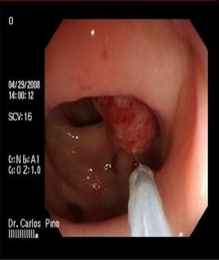 polipo_polipectomia_endoscopica/polipo_polipectomia2