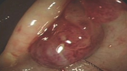 polipo_polipectomia_endoscopica/restos_polipos polipo_polipectomia_endoscopica/restos_polipos