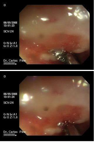 proctocolitis_cronica_radiacion/biopsia_lesiones_recto