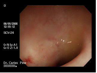 proctocolitis_cronica_radiacion/mucosa_adyacente_lesion