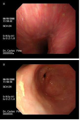 proctocolitis_cronica_radiacion/mucosa_distal_esofago