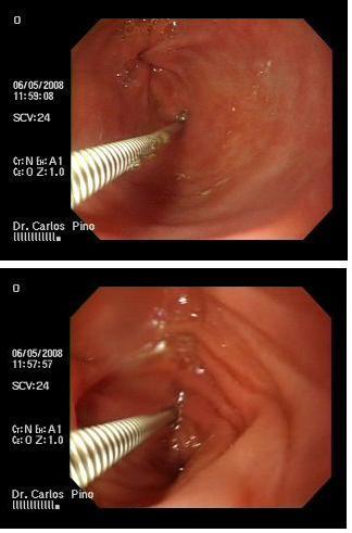 proctocolitis_cronica_radiacion/mucosa_gastrica_lesion