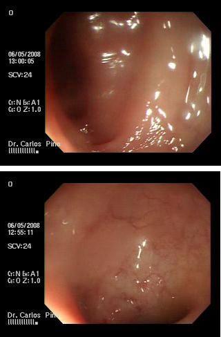 proctocolitis_cronica_radiacion/mucosa_normal_endoscopia