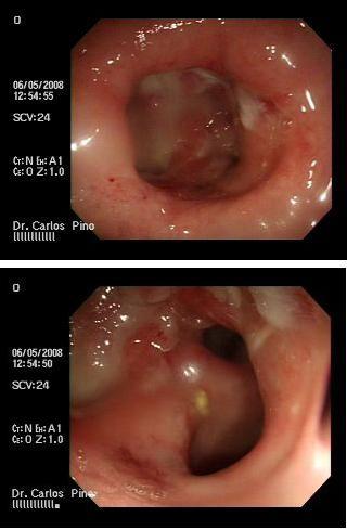 proctocolitis_cronica_radiacion/mucosa_rectal_ulcerada