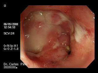 proctocolitis_cronica_radiacion/mucosa_ulcerada_deprimida