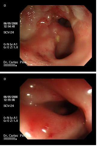 proctocolitis_cronica_radiacion/mucosa_ulcerada_friable