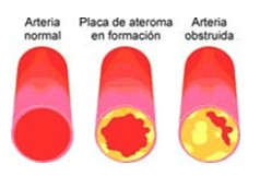 quelacion_terapia_quelante /arteriosclerosis_aterosclerosis_arteria