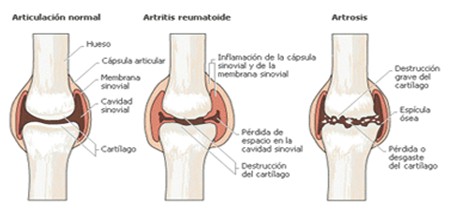 quelacion_terapia_quelante /artrosis_destruccion_articular