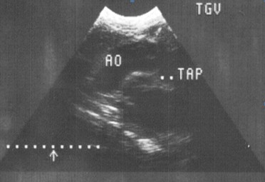 sindrome_Ivemark_isomerismo/arteria_pulmonar_aorta sindrome_Ivemark_isomerismo/arteria_pulmonar_aorta